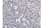 The image on the left is immunohistochemistry of paraffin-embedded Human thyroid cancer tissue using CSB-PA829714(FES Antibody) at dilution 1/25, on the right is treated with fusion protein. (Original magnification: 