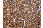 The image on the left is immunohistochemistry of paraffin-embedded Human thyroid cancer tissue using CSB-PA830149(BMP6 Antibody) at dilution 1/40, on the right is treated with synthetic peptide. (Original magnification: 