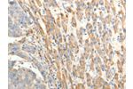 The image on the left is immunohistochemistry of paraffin-embedded Human liver cancer tissue using CSB-PA830383(BIRC2 Antibody) at dilution 1/20, on the right is treated with fusion protein. (Original magnification: 