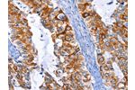 The image on the left is immunohistochemistry of paraffin-embedded Human cervical cancer tissue using CSB-PA830451(ARRB1 Antibody) at dilution 1/50, on the right is treated with fusion protein. (Original magnification: 
