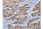The image on the left is immunohistochemistry of paraffin-embedded Human esophagus cancer tissue using CSB-PA830643(EPHA4 Antibody) at dilution 1/15, on the right is treated with synthetic peptide. (Original magnification: 