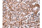 The image on the left is immunohistochemistry of paraffin-embedded Human thyroid cancer tissue using CSB-PA831162(ARRB1 Antibody) at dilution 1/15, on the right is treated with synthetic peptide. (Original magnification: 