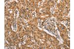 The image on the left is immunohistochemistry of paraffin-embedded Human gastic cancer tissue using CSB-PA831164(CRKL Antibody) at dilution 1/25, on the right is treated with synthetic peptide. (Original magnification: 