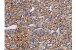 The image on the left is immunohistochemistry of paraffin-embedded Human prostate cancer tissue using CSB-PA831601(GHITM Antibody) at dilution 1/30, on the right is treated with fusion protein. (Original magnification: 