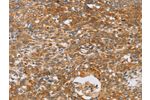 The image on the left is immunohistochemistry of paraffin-embedded Human cervical cancer tissue using CSB-PA831796(CRELD2 Antibody) at dilution 1/40, on the right is treated with fusion protein. (Original magnification: 