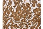 The image on the left is immunohistochemistry of paraffin-embedded Human breast cancer tissue using CSB-PA831848(DLL4 Antibody) at dilution 1/50, on the right is treated with fusion protein. (Original magnification: 
