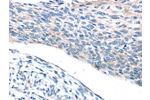 The image on the left is immunohistochemistry of paraffin-embedded Human esophagus cancer tissue using CSB-PA831980(ADRB3 Antibody) at dilution 1/25, on the right is treated with synthetic peptide. (Original magnification: 