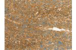 The image on the left is immunohistochemistry of paraffin-embedded Human liver cancer tissue using CSB-PA832036(APOL2 Antibody) at dilution 1/80, on the right is treated with synthetic peptide. (Original magnification: 