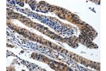 The image on the left is immunohistochemistry of paraffin-embedded Human colorectal cancer tissue using CSB-PA832691(BCL2 Antibody) at dilution 1/20, on the right is treated with synthetic peptide. (Original magnification: 