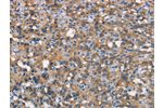 The image on the left is immunohistochemistry of paraffin-embedded Human thyroid cancer tissue using CSB-PA832895(CEACAM6 Antibody) at dilution 1/70, on the right is treated with synthetic peptide. (Original magnification: 