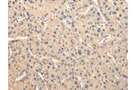 The image on the left is immunohistochemistry of paraffin-embedded Human liver cancer tissue using CSB-PA833161(DUSP11 Antibody) at dilution 1/50, on the right is treated with fusion protein. (Original magnification: 