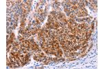 The image on the left is immunohistochemistry of paraffin-embedded Human liver cancer tissue using CSB-PA834531(AADAC Antibody) at dilution 1/30, on the right is treated with fusion protein. (Original magnification: 