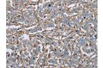 The image on the left is immunohistochemistry of paraffin-embedded Human liver cancer tissue using CSB-PA834684(FCGR2B Antibody) at dilution 1/40, on the right is treated with fusion protein. (Original magnification: 