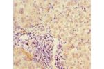 Immunohistochemistry of paraffin-embedded human liver cancer using CSB-PA835697ESR1HU at dilution 1:100