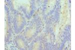 Immunohistochemistry of paraffin-embedded human colon cancer using CSB-PA835890ESR2HU at dilution 1:100