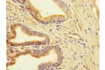 Immunohistochemistry of paraffin-embedded human prostate cancer using CSB-PA836181LA01HU at dilution of 1:100