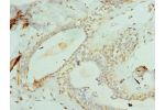 Immunohistochemistry of paraffin-embedded human breast cancer using CSB-PA836209LA01HU at dilution of 1:100