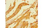 Immunohistochemistry of paraffin-embedded human endometrial cancer using CSB-PA836244LA01HU at dilution of 1:100