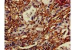 Immunohistochemistry of paraffin-embedded human lung cancer using CSB-PA836675LA01HU at dilution of 1:100