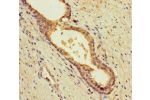 Immunohistochemistry of paraffin-embedded human prostate cancer using CSB-PA837439LA01HU at dilution of 1:100