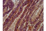 IHC image of CSB-PA837445LA01HU diluted at 1:400 and staining in paraffin-embedded human colon cancer performed on a Leica BondTM system. After dewaxing and hydration, antigen retrieval was mediated by high pressure in a citrate buffer (pH 6.0). Section w