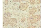 Immunohistochemistry of paraffin-embedded human gastric cancer using CSB-PA837852LA01HU at dilution of 1:100