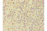 Immunohistochemistry of paraffin-embedded human breast cancer using CSB-PA837883ESR1HU at dilution 1:100