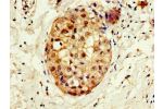 Immunohistochemistry of paraffin-embedded human breast cancer using CSB-PA838805LA01HU at dilution of 1:100