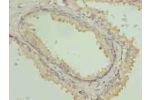 Immunohistochemistry of paraffin-embedded human prostate cancer using CSB-PA839348LA01HU at dilution of 1:100