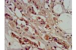 IHC image of CSB-PA839416LA01HU diluted at 1:400 and staining in paraffin-embedded human breast cancer performed on a Leica BondTM system. After dewaxing and hydration, antigen retrieval was mediated by high pressure in a citrate buffer (pH 6.0). Section 