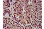 IHC image of CSB-PA839829LA01HU diluted at 1:200 and staining in paraffin-embedded human pancreatic cancer performed on a Leica BondTM system. After dewaxing and hydration, antigen retrieval was mediated by high pressure in a citrate buffer (pH 6.0). Sect