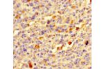 Immunohistochemistry of paraffin-embedded human melanoma cancer using CSB-PA840974LA01HU at dilution of 1:100