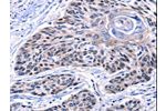 The image on the left is immunohistochemistry of paraffin-embedded Human esophagus cancer tissue using CSB-PA841031(CCNB2 Antibody) at dilution 1/10, on the right is treated with synthetic peptide. (Original magnification: 