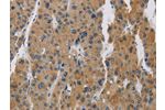 The image is immunohistochemistry of paraffin-embedded Human liver cancer tissue using CSB-PA841149(BCL2L12 Antibody) at dilution 1/20. (Original magnification: 