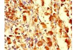 Immunohistochemistry of paraffin-embedded human melanoma cancer using CSB-PA842170LA01HU at dilution of 1:100