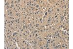 The image on the left is immunohistochemistry of paraffin-embedded Human liver cancer tissue using CSB-PA842443(ALDH8A1 Antibody) at dilution 1/40, on the right is treated with fusion protein. (Original magnification: 