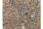 The image on the left is immunohistochemistry of paraffin-embedded Human cervical cancer tissue using CSB-PA842510(BCAT2 Antibody) at dilution 1/70, on the right is treated with fusion protein. (Original magnification: 