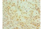 Immunohistochemistry of paraffin-embedded human breast cancer using CSB-PA842636ESR1HU at dilution 1:100