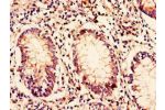 Immunohistochemistry of paraffin-embedded human colon cancer using CSB-PA842639LA01HU at dilution of 1:100
