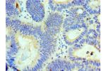 Immunohistochemistry of paraffin-embedded human colon cancer using CSB-PA842644ESR1HU at dilution 1:100