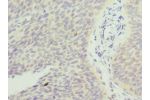 Immunohistochemistry of paraffin-embedded human cervical cancer using CSB-PA842655DSR1HU at dilution 1:100