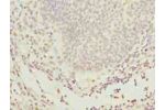 Immunohistochemistry of paraffin-embedded human bladder carcinoma using CSB-PA842719LA01HU at dilution of 1:100