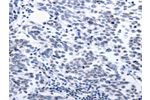 The image on the left is immunohistochemistry of paraffin-embedded Human breast cancer tissue using CSB-PA843257(CCND1 Antibody) at dilution 1/25, on the right is treated with synthetic peptide. (Original magnification: 