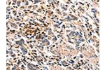 The image on the left is immunohistochemistry of paraffin-embedded Human gastic cancer tissue using CSB-PA845102(FOXB2 Antibody) at dilution 1/5, on the right is treated with synthetic peptide. (Original magnification: 