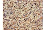 Immunohistochemistry of paraffin-embedded human liver cancer using CSB-PA845163LA01HU at dilution of 1:100