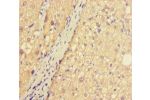 Immunohistochemistry of paraffin-embedded human liver cancer using CSB-PA845168LA01HU at dilution of 1:100