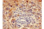 Immunohistochemistry of paraffin-embedded human melanoma cancer using CSB-PA846590LA01HU at dilution of 1:100
