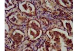 IHC image of CSB-PA846652LA01HU diluted at 1:200 and staining in paraffin-embedded human liver cancer performed on a Leica BondTM system. After dewaxing and hydration, antigen retrieval was mediated by high pressure in a citrate buffer (pH 6.0). Section w