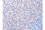 The image on the left is immunohistochemistry of paraffin-embedded Human liver cancer tissue using CSB-PA846755(EGF Antibody) at dilution 1/25, on the right is treated with fusion protein. (Original magnification: 