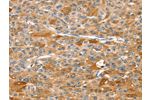 The image on the left is immunohistochemistry of paraffin-embedded Human liver cancer tissue using CSB-PA846981(DSTYK Antibody) at dilution 1/25, on the right is treated with fusion protein. (Original magnification: 